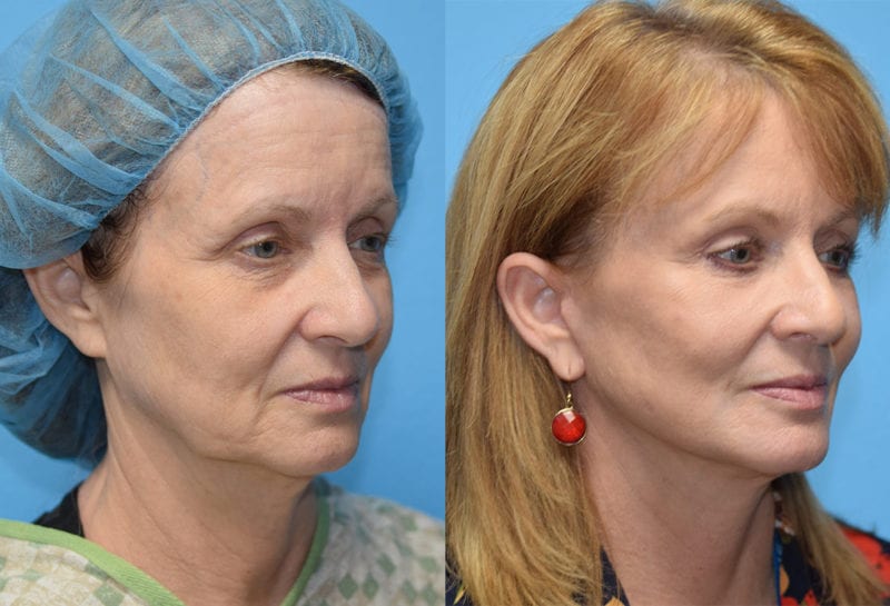 Facelift results at Maningas Cosmetic Surgery in Joplin, MO and Northwest Arkansas