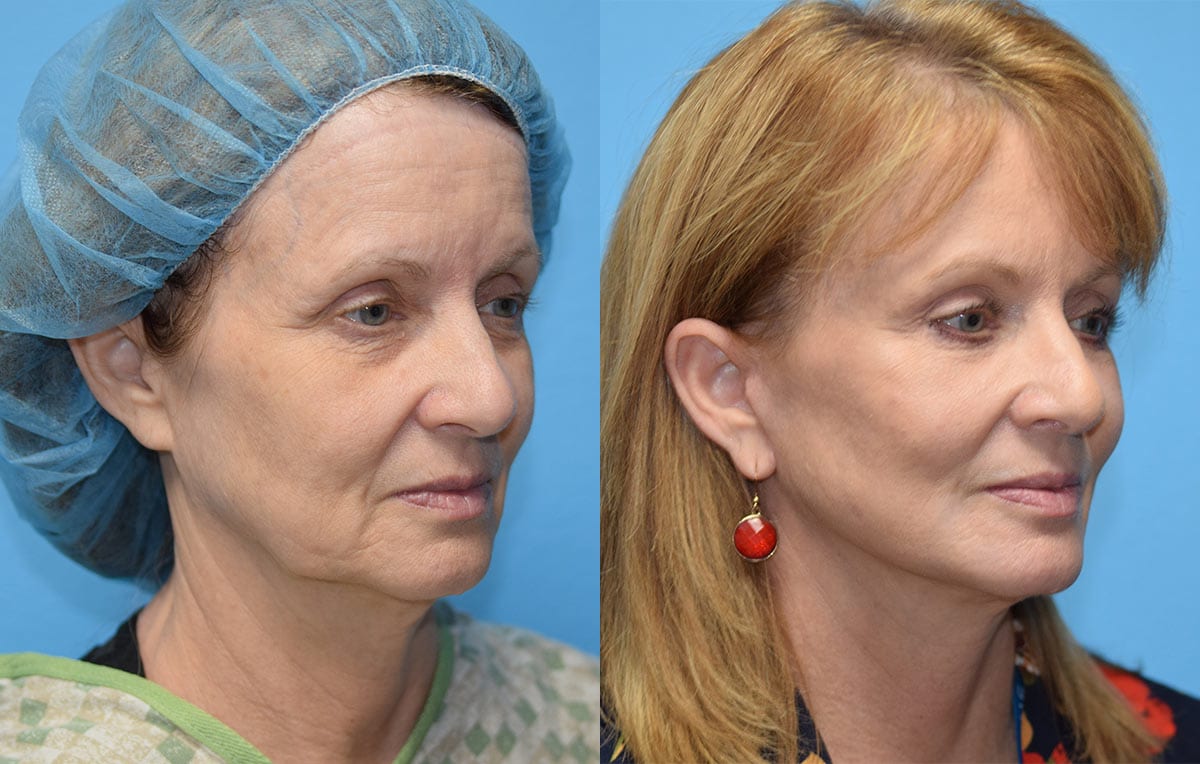 Facelift results at Maningas Cosmetic Surgery in Joplin, MO and Northwest Arkansas