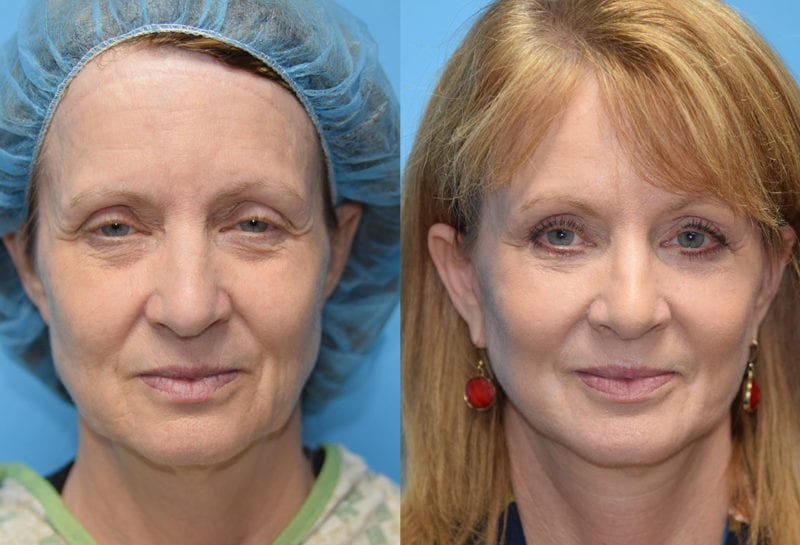 Facelift results at Maningas Cosmetic Surgery in Joplin, MO and Northwest Arkansas