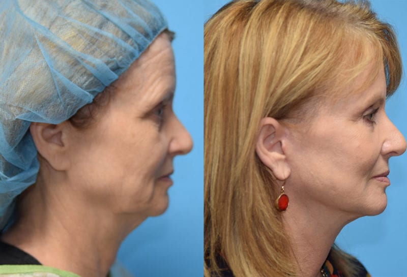 Facelift results at Maningas Cosmetic Surgery in Joplin, MO and Northwest Arkansas