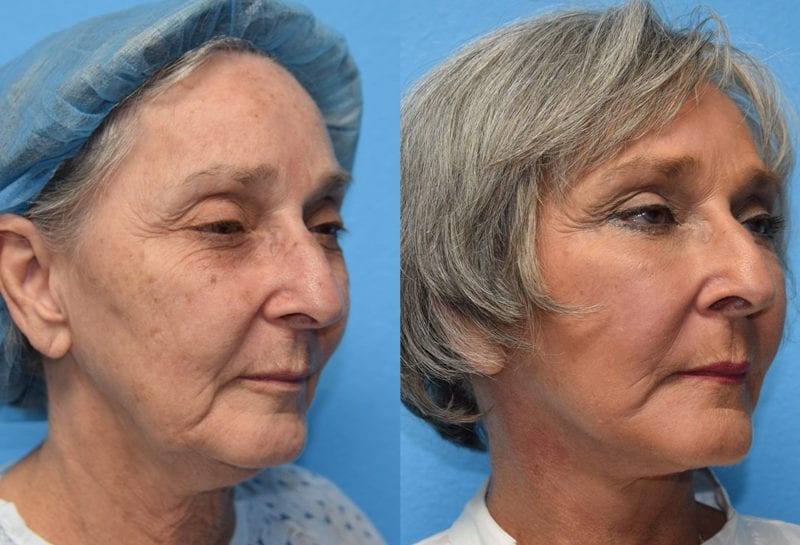 Facelift results at Maningas Cosmetic Surgery in Joplin, MO and Northwest Arkansas