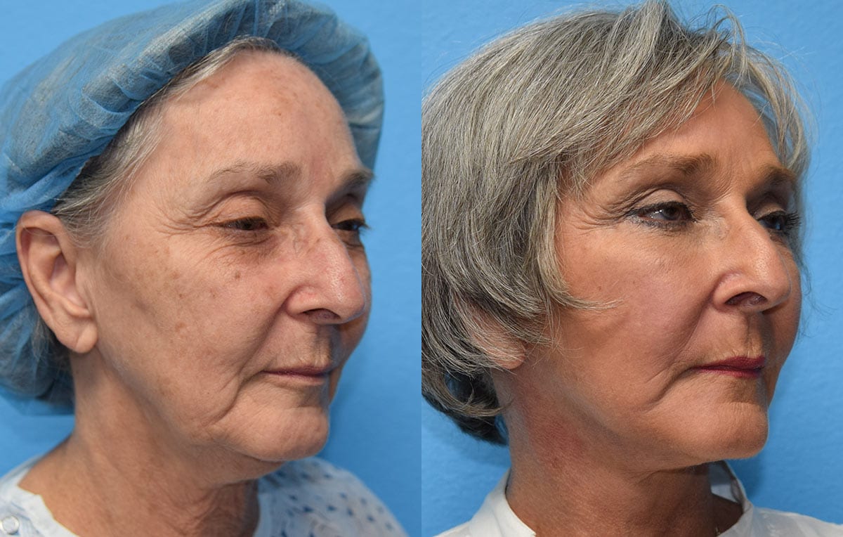 Facelift results at Maningas Cosmetic Surgery in Joplin, MO and Northwest Arkansas