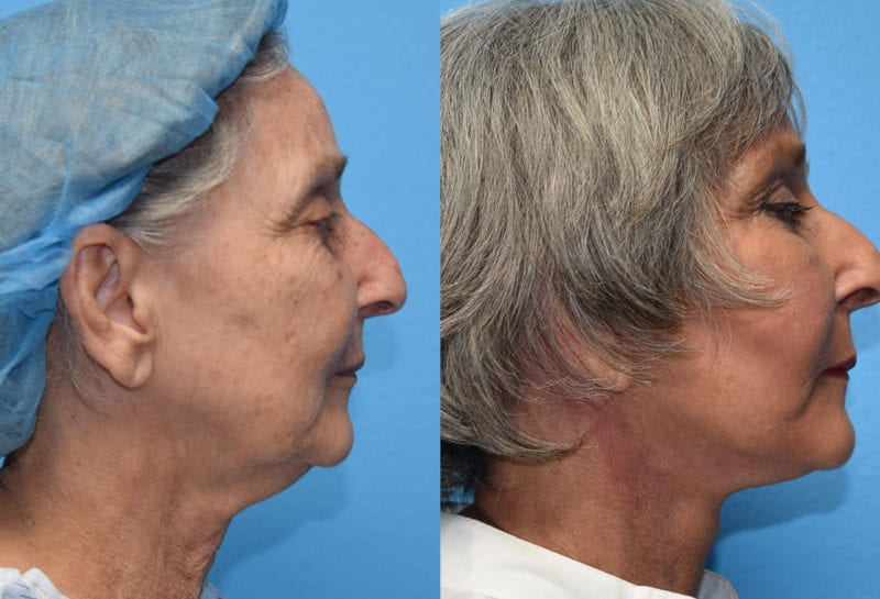 Facelift results at Maningas Cosmetic Surgery in Joplin, MO and Northwest Arkansas