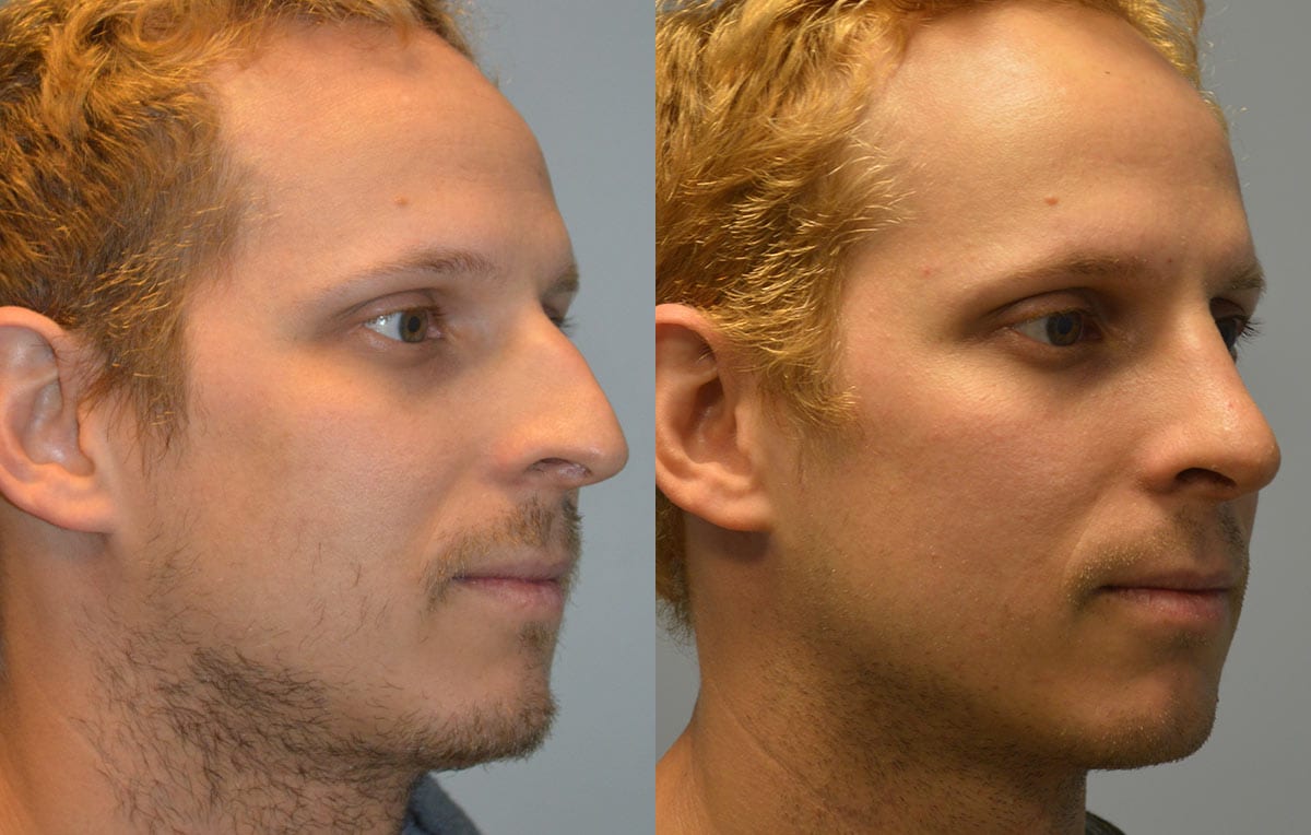 Nose reshaping results at Maningas Cosmetic Surgery in Joplin, MO and Northwest Arkansas