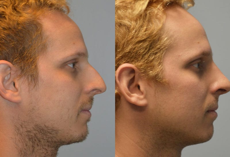 Nose reshaping results at Maningas Cosmetic Surgery in Joplin, MO and Northwest Arkansas