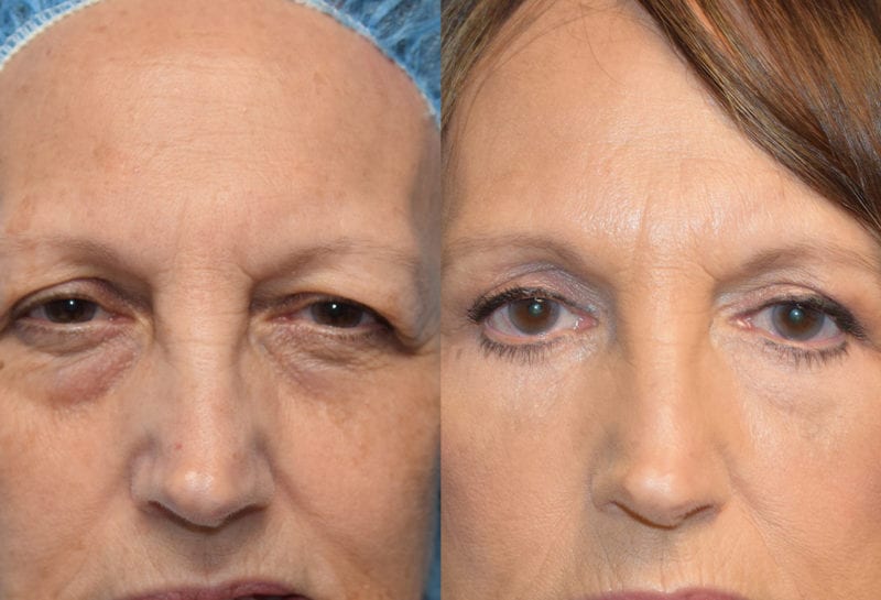 Eyelid surgery results at Maningas Cosmetic Surgery in Joplin, MO and Northwest Arkansas