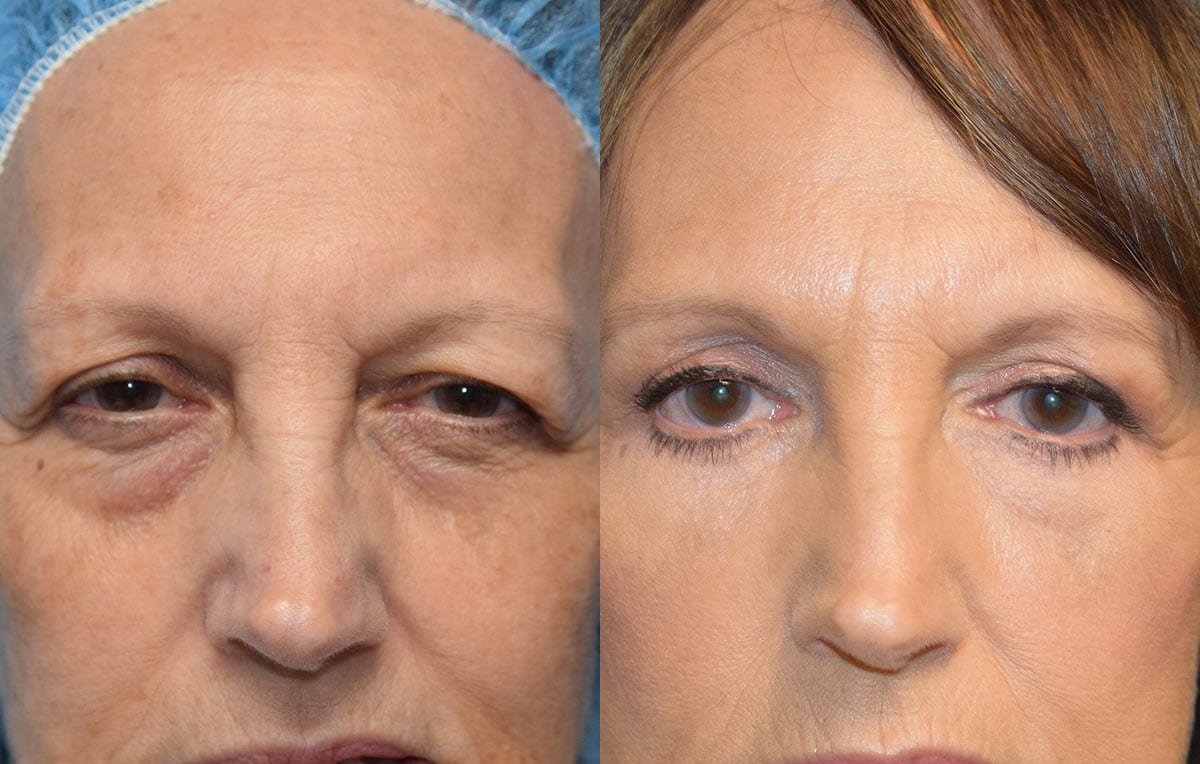 Eyelid surgery results at Maningas Cosmetic Surgery in Joplin, MO and Northwest Arkansas