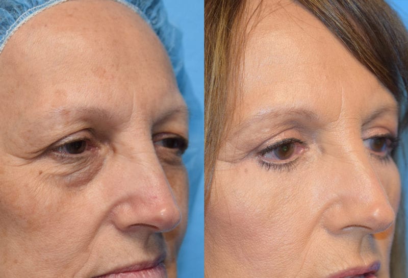 Eyelid surgery results at Maningas Cosmetic Surgery in Joplin, MO and Northwest Arkansas