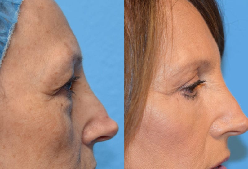 Eyelid surgery results at Maningas Cosmetic Surgery in Joplin, MO and Northwest Arkansas