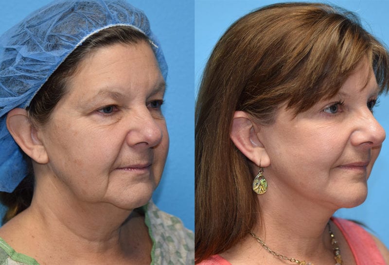 Facelift results at Maningas Cosmetic Surgery in Joplin, MO and Northwest Arkansas