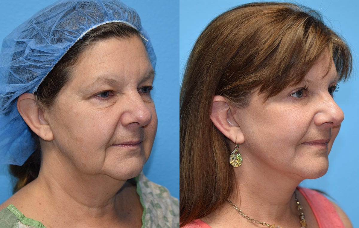 Facelift results at Maningas Cosmetic Surgery in Joplin, MO and Northwest Arkansas