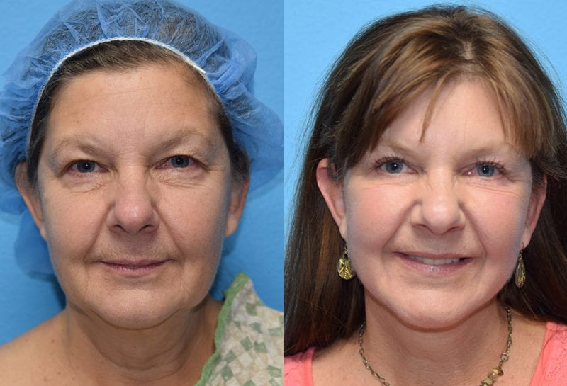 Facelift results at Maningas Cosmetic Surgery in Joplin, MO and Northwest Arkansas