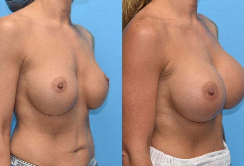 Cosmetic breast revision results by Dr. Maningas at Maningas Cosmetic Surgery in Missouri and Arkansas