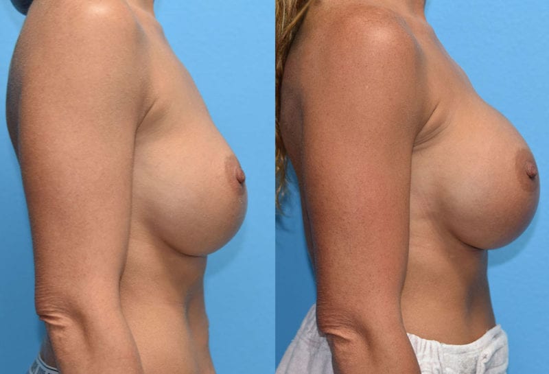 Cosmetic breast revision results by Dr. Maningas at Maningas Cosmetic Surgery in Missouri and Arkansas