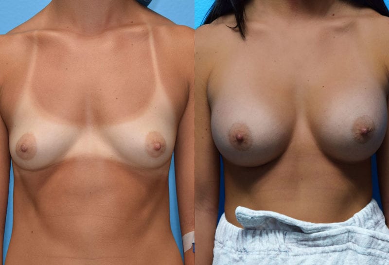 breast augmentation results by dr. maningas at maningas cosmetic surgery in joplin, mo