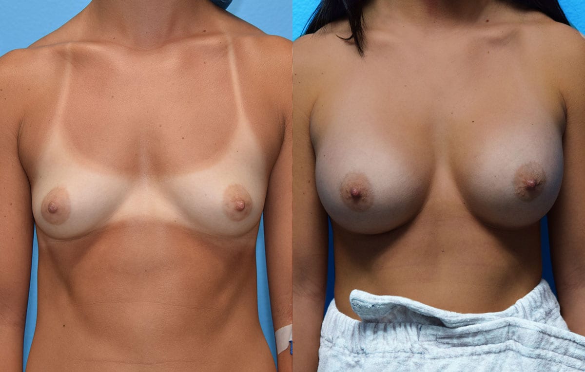 breast augmentation results by dr. maningas at maningas cosmetic surgery in joplin, mo