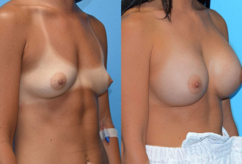 breast augmentation results by dr. maningas at maningas cosmetic surgery in joplin, mo