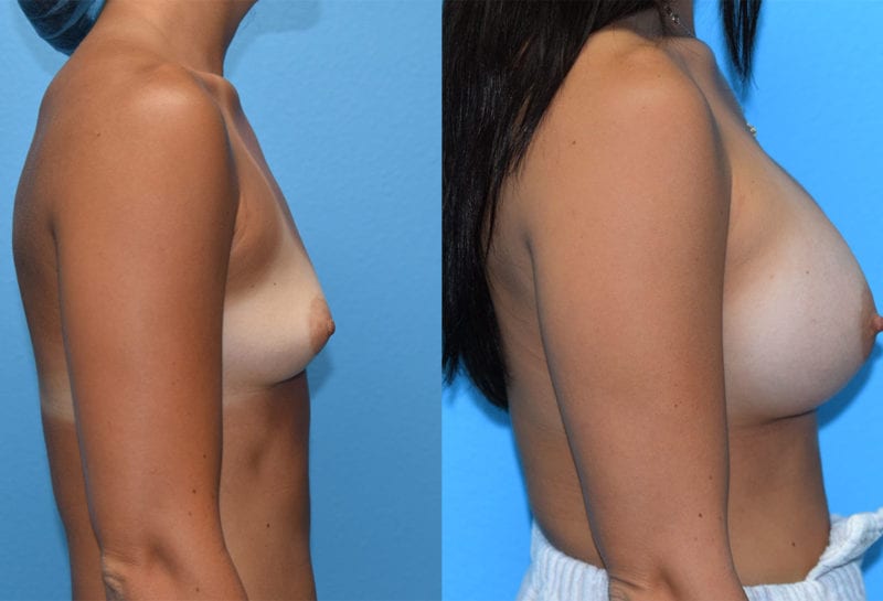 breast augmentation results by dr. maningas at maningas cosmetic surgery in joplin, mo