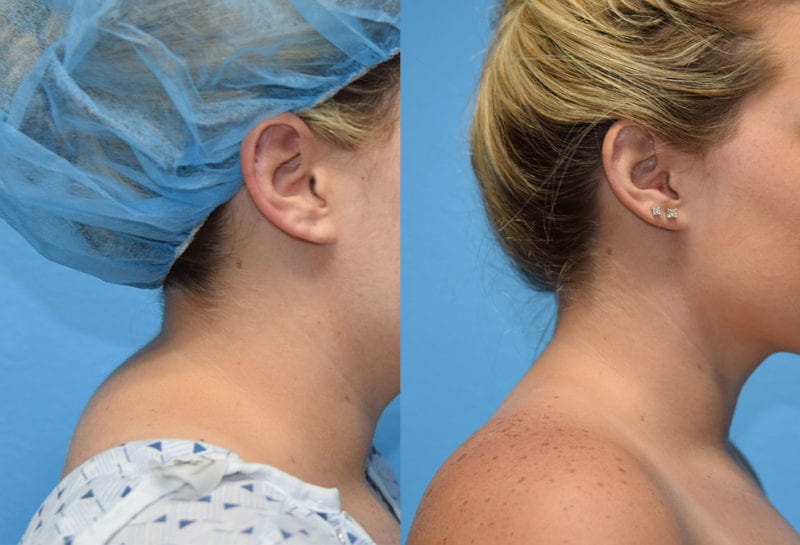 Liposuction to remove buffalo hump at Maningas Cosmetic Surgery in Joplin, MO