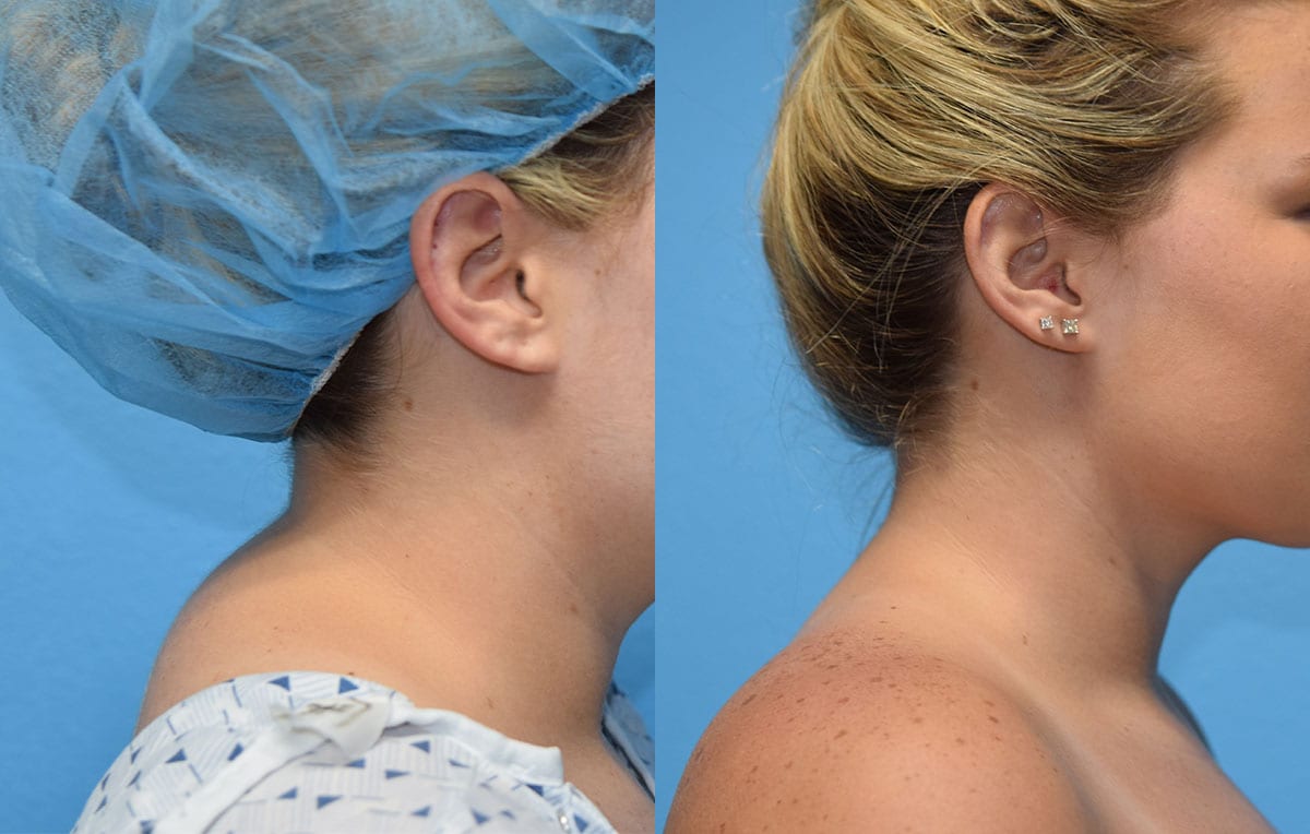 Liposuction to remove buffalo hump at Maningas Cosmetic Surgery in Joplin, MO