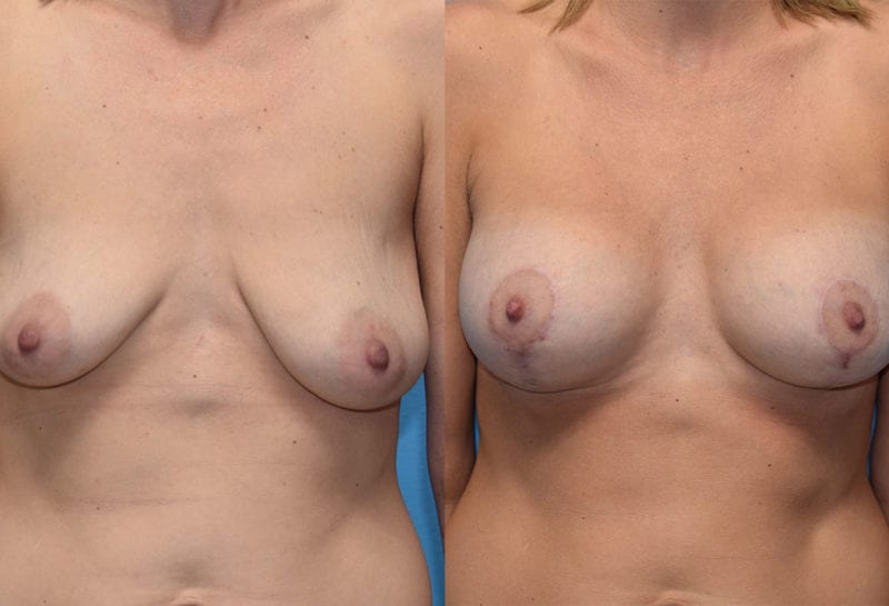 Breast Lift with Implant results by Dr. Maningas at Maningas Cosmetic Surgery in Missouri and Arkansas