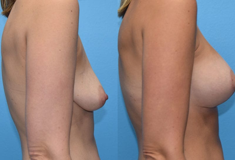 Breast Lift with Implant results by Dr. Maningas at Maningas Cosmetic Surgery in Missouri and Arkansas