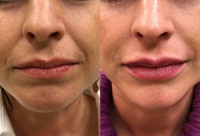 Lip Filler in Joplin, MO at Maningas Cosmetics Surgery