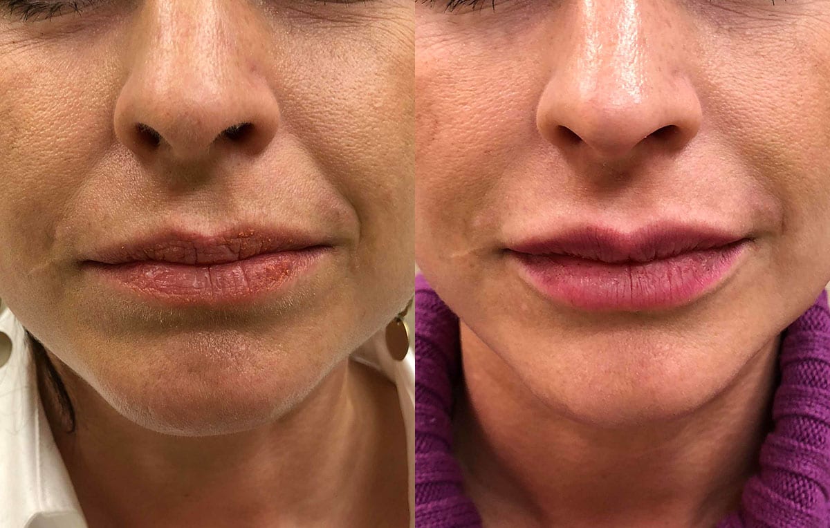 Lip Filler in Joplin, MO at Maningas Cosmetics Surgery