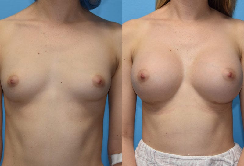 breast augmentation results by dr. maningas at maningas cosmetic surgery in joplin, mo