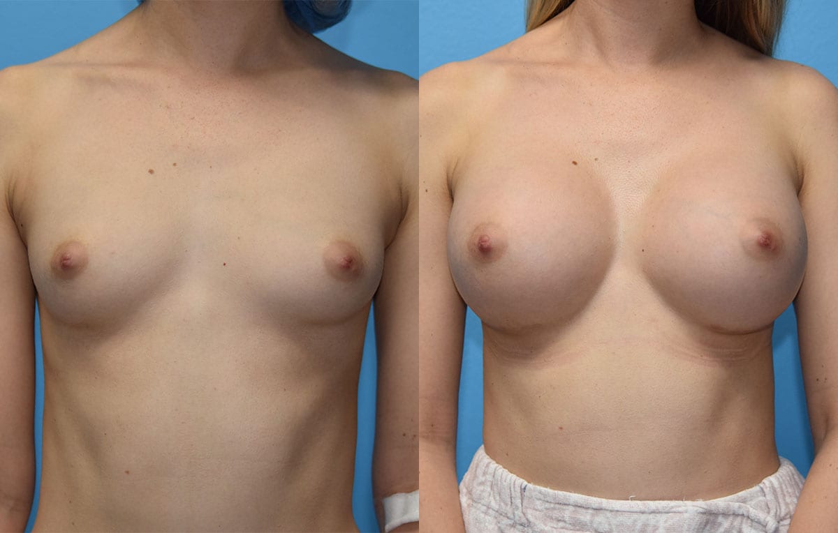 breast augmentation results by dr. maningas at maningas cosmetic surgery in joplin, mo