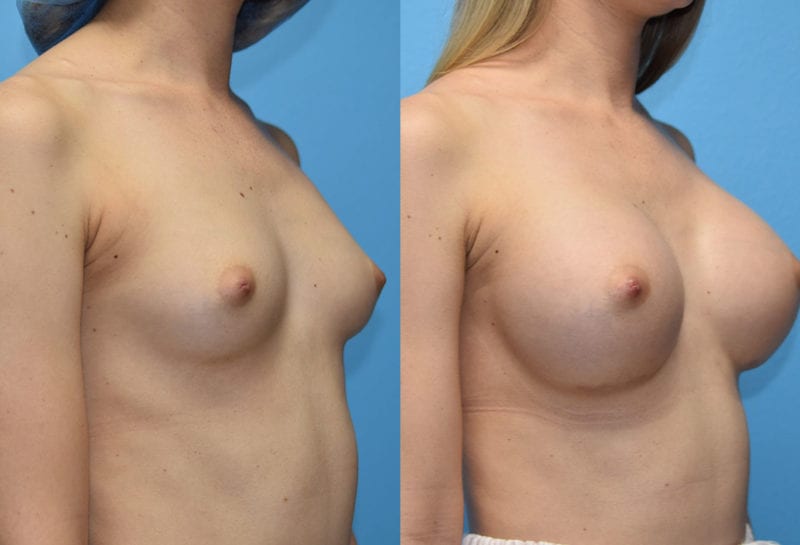 breast augmentation results by dr. maningas at maningas cosmetic surgery in joplin, mo