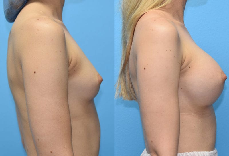 breast augmentation results by dr. maningas at maningas cosmetic surgery in joplin, mo