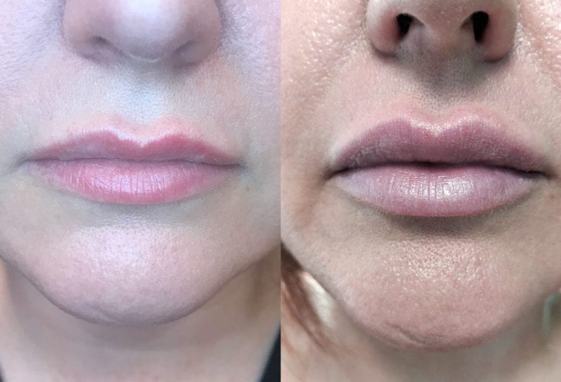 Lip Filler in Joplin, MO at Maningas Cosmetics Surgery