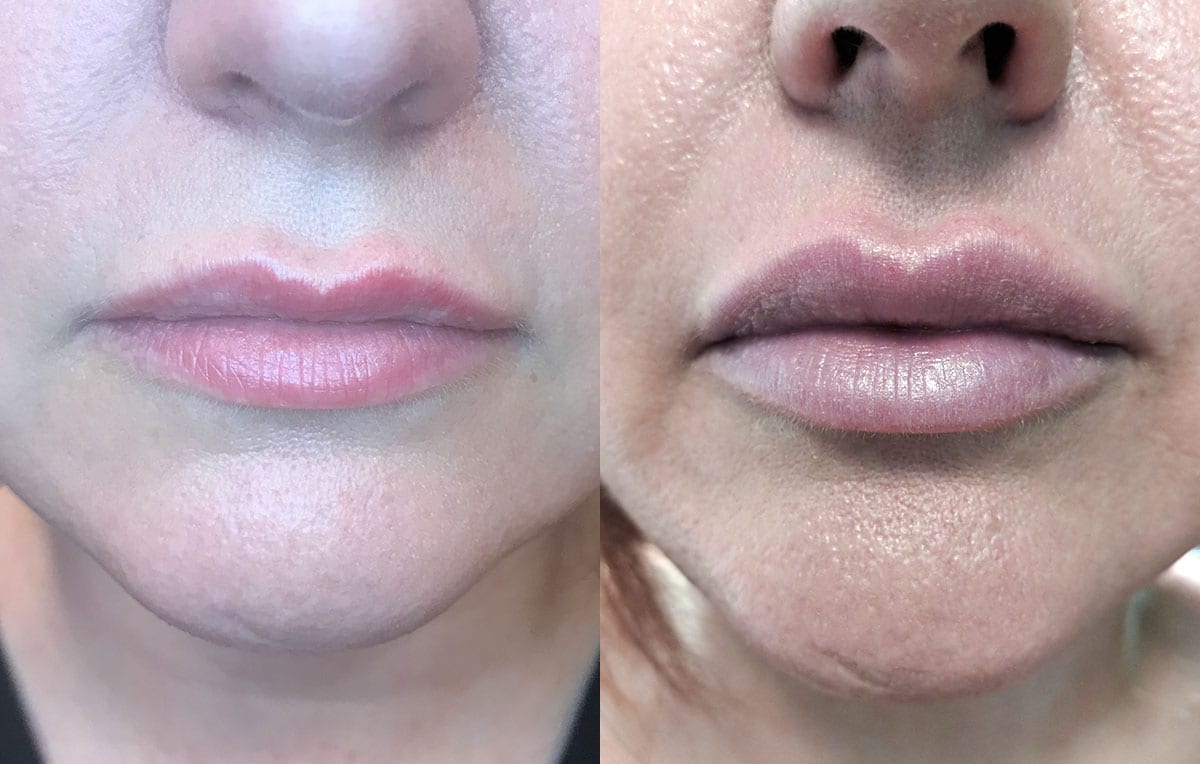 Lip Filler in Joplin, MO at Maningas Cosmetics Surgery