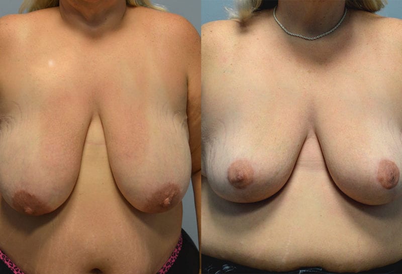 breast reduction results by Dr. Maningas as Maningas Cosmetic Surgery