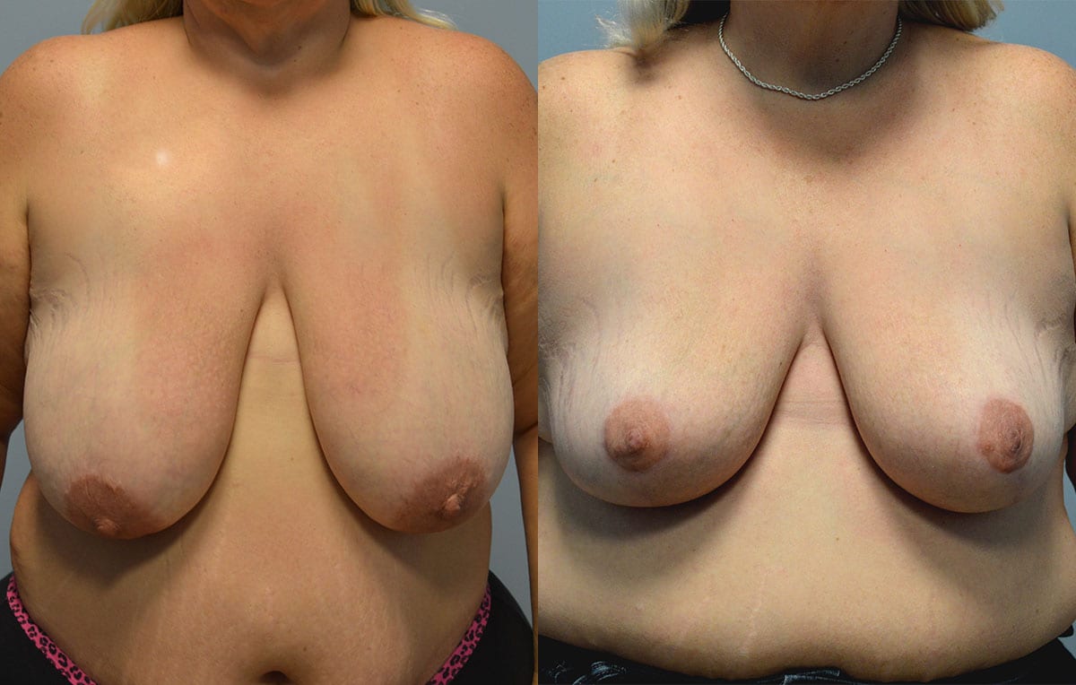 breast reduction results by Dr. Maningas as Maningas Cosmetic Surgery