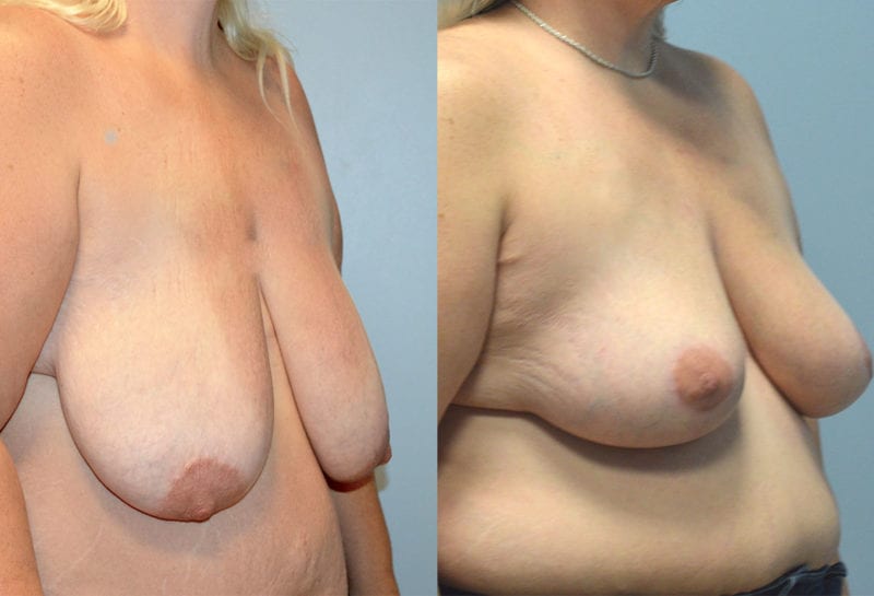 breast reduction results by Dr. Maningas as Maningas Cosmetic Surgery