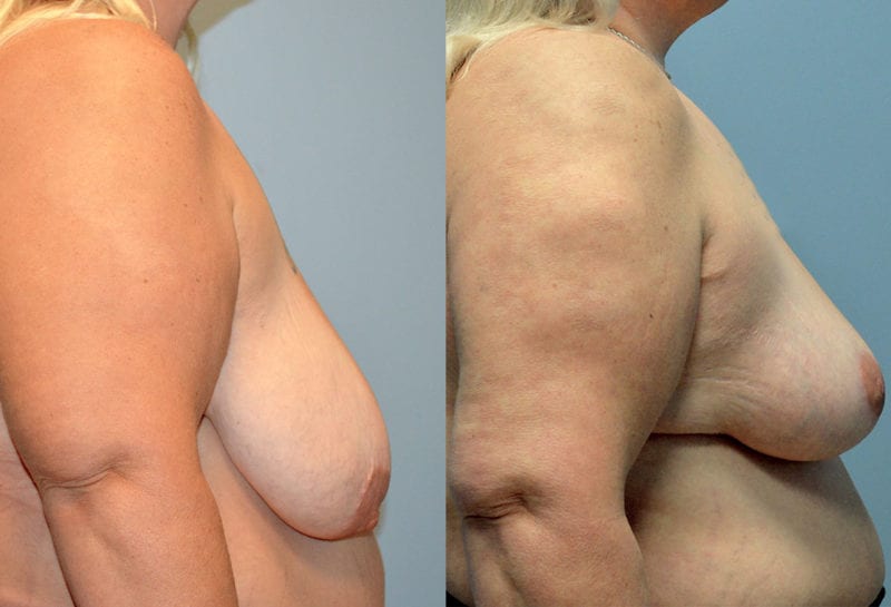 breast reduction results by Dr. Maningas as Maningas Cosmetic Surgery