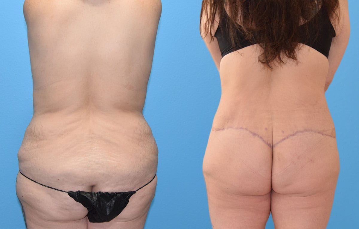 Body Lift results by Dr. Maningas at Maningas Cosmetic Surgery in Joplin, MO