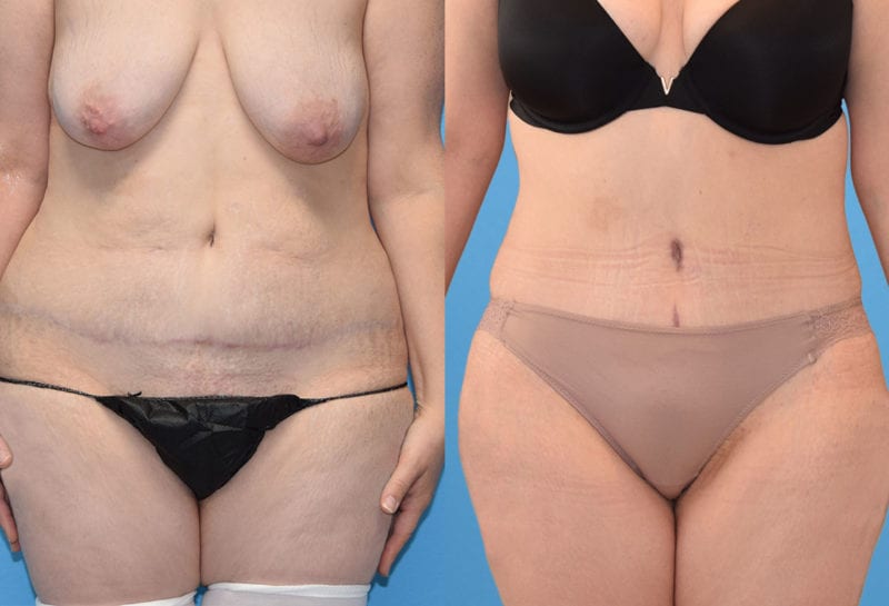 Tummy tuck results by Dr. Maningas at Maningas Cosmetic Surgery in Joplin, MO