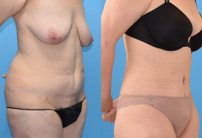 Tummy tuck results by Dr. Maningas at Maningas Cosmetic Surgery in Joplin, MO