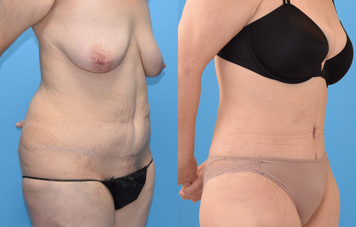 Tummy tuck results by Dr. Maningas at Maningas Cosmetic Surgery in Joplin, MO