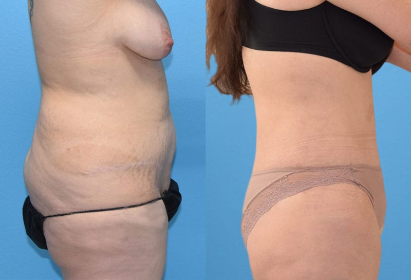 Tummy tuck results by Dr. Maningas at Maningas Cosmetic Surgery in Joplin, MO