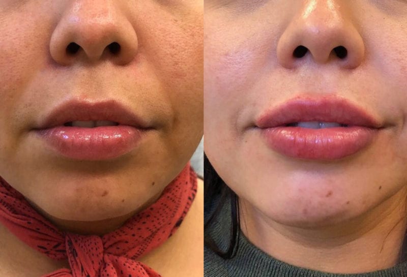 Lip Filler in Joplin, MO at Maningas Cosmetics Surgery