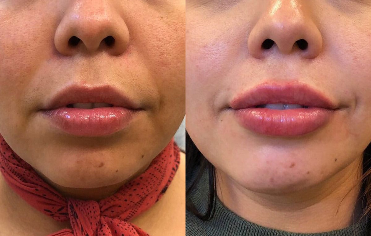 Lip Filler in Joplin, MO at Maningas Cosmetics Surgery