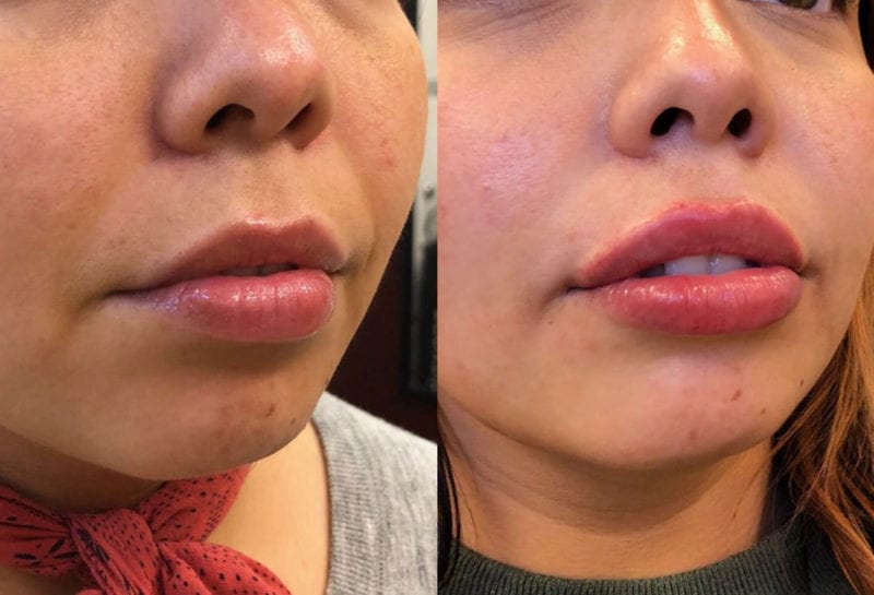 Lip Filler in Joplin, MO at Maningas Cosmetics Surgery