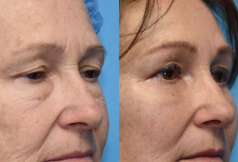 Eyelid and Brow Lift surgery results at Maningas Cosmetic Surgery in Joplin, MO and Northwest Arkansas