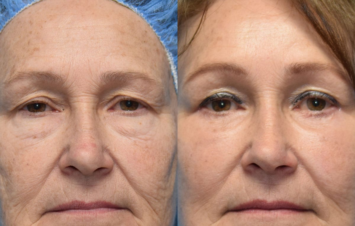 Eyelid and Brow Lift surgery results at Maningas Cosmetic Surgery in Joplin, MO and Northwest Arkansas