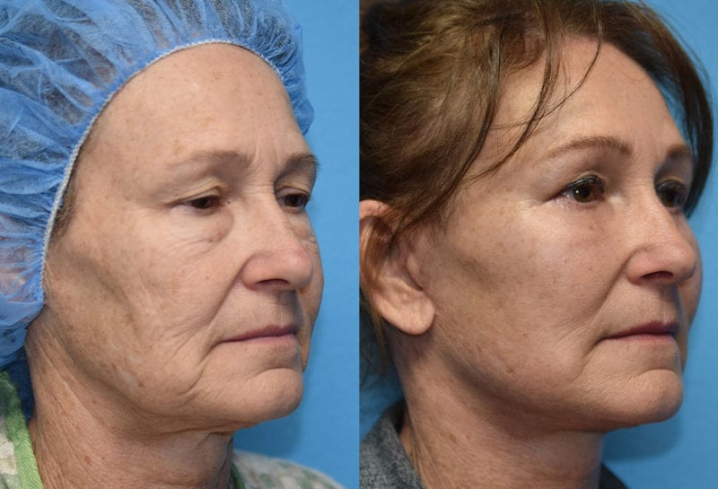 Facelift results at Maningas Cosmetic Surgery in Joplin, MO and Northwest Arkansas