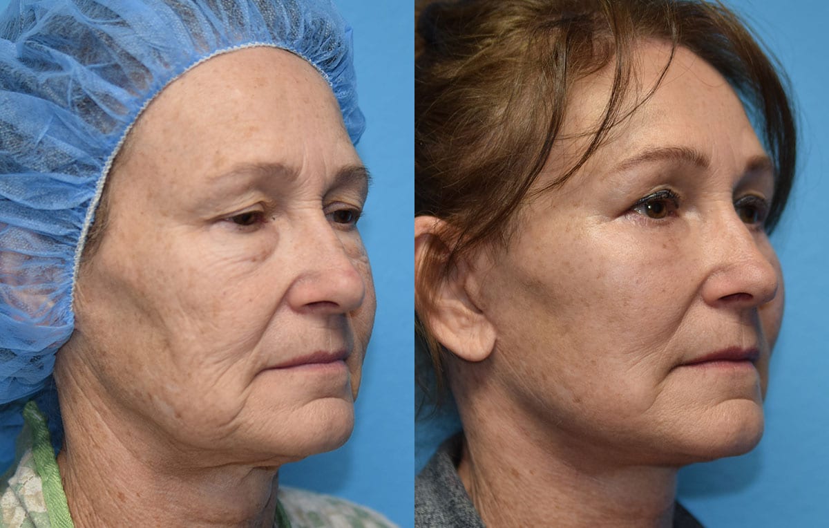 Facelift results at Maningas Cosmetic Surgery in Joplin, MO and Northwest Arkansas